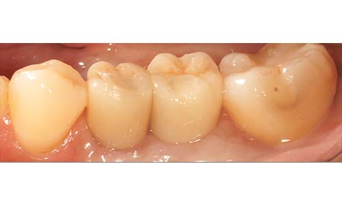 case C牙齦萎縮2a