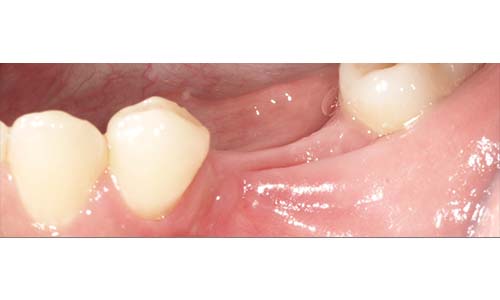 case C牙齦萎縮2b